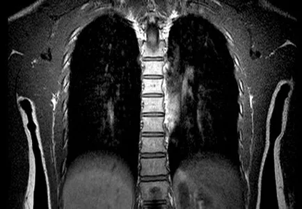 Megfejtése a mellüreg MRI