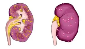 Remisszió krónikus prostatitis, krónikus prosztatitisz remisszióban