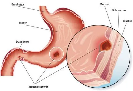 Reflux gastritis tünetek és a kezelés Duodenitis