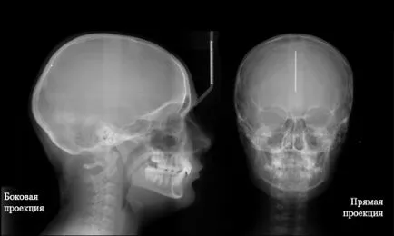 raze X (radiografii) ale creierului copilului și adultului