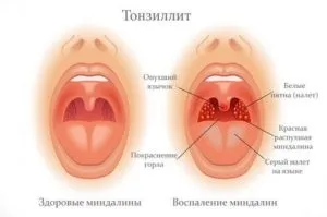 Заразний чи тонзиліт для оточуючих (триває інкубаційний період) Заразний чи тонзиліт для оточуючих