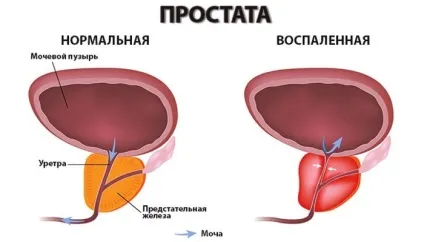 Запущений простатит у чоловіків - небезпека і лікування захворювання (чоловіків) Запущений простатит у чоловіків - небезпека і лікування захворювання