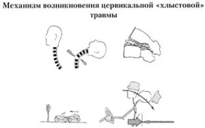 Nyaki-cranialis szindróma (tservikokranialgiya Vertebrogenic szindróma és más fajok)