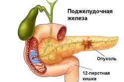 Симптоми на заболявания на жлъчния мехур и панкреаса