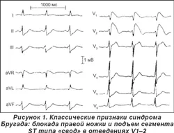 Brugada semne ECG sindrom, simptome și tratament