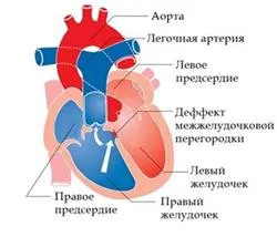Синдром wpw на ЕКГ (обхід атріовентрикулярного вузла) Синдром wpw на ЕКГ