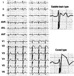 Brugada szindróma EKG jelek, tünetek és a kezelés
