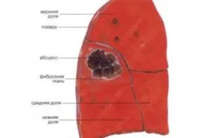 Simptome, diagnostic și tratament de pneumonie, abces