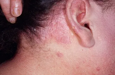 Tünetei dermatitis felnőtteknél