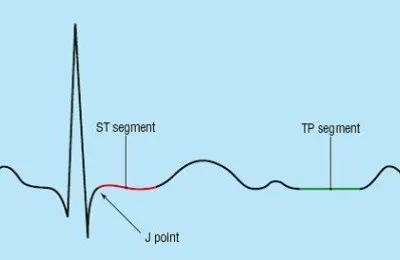 Brugada szindróma EKG jelek és tünetek