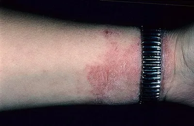 Tünetei dermatitis felnőtteknél