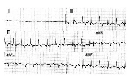 Sinus tachycardia kutyáknál