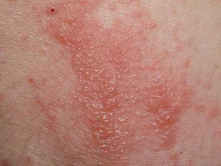 Simptome și semne de dermatită la adulți