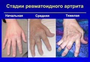 Життя з ревматоїдним артритом - симптоми, лікування, профілактика