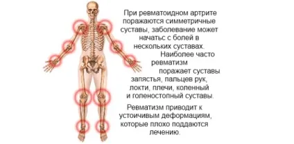 Життя з ревматоїдним артритом - симптоми, лікування, профілактика