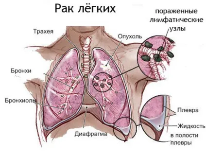 Рідина в легенях при онкології симптоми і ознаки, лікування і прогноз