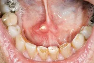Ptyalolithiasis - pietre în simptomele glandelor salivare și tratamentul cu fotografii