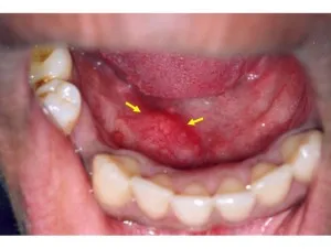 Ptyalolithiasis - pietre în simptomele glandelor salivare și tratamentul cu fotografii