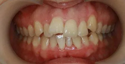 Tolonganak a fogak - okai, szövődményei és kezelése
