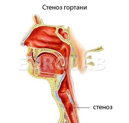 Stenoza a laringelui la copii - simptome, prevenirea și tratamentul stenozei laringian la copii, cauze