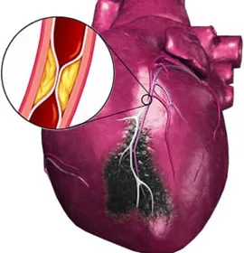 infarct miocardic subendocardică care este, ECG