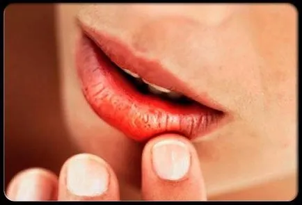 Uscăciunea gurii - un semn care este motivul pentru buzele crăpate viața mea
