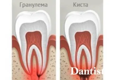 Терапевтични методи на лечение на зъб кисти, цена и снимки