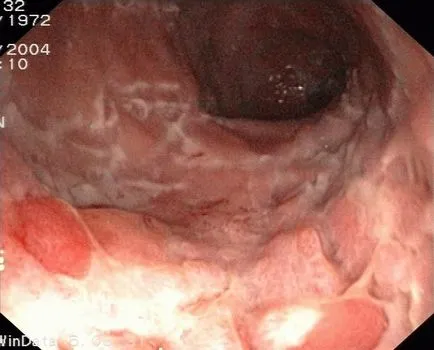 ileita terminală (inflamație a ileonului, boala Crohn intestinale), simptome, tratament,