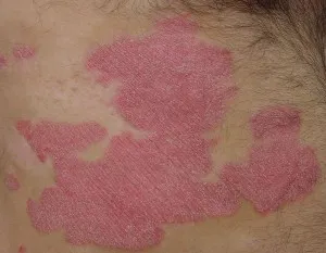 Típusú psoriasis - kezelésére és diagnosztizálására plaque psoriasis - útmutató a bőrbetegségek