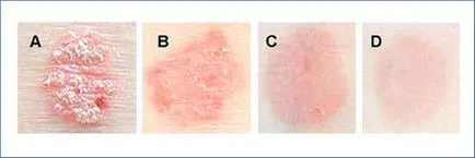 Típusú psoriasis - kezelésére és diagnosztizálására plaque psoriasis - útmutató a bőrbetegségek