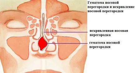 нараняване на носа може да застраши развитието на хематом на носната преграда