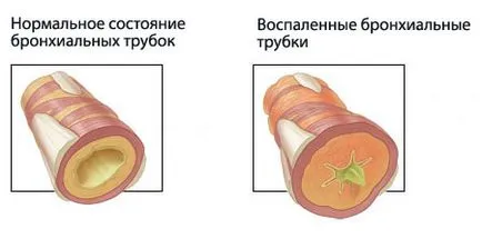 Copilul are o tuse și muci fără temperatură decât periculoase și cum se vindeca tusea