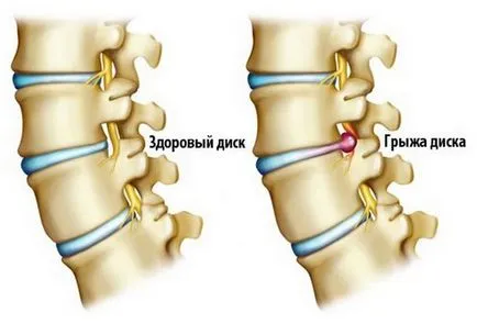 Gyakorlatok osteochondrosis az ágyéki gerinc Videó