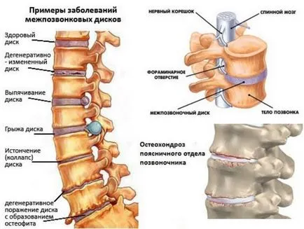 Gyakorlatok osteochondrosis az ágyéki gerinc Videó