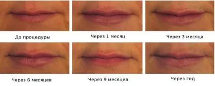 Mărirea buzelor fotografii înainte și după injectarea de acid hialuronic în buze