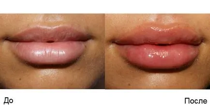 Ajakfeltöltés képek előtt és után az injekció hialuronsav az ajkak