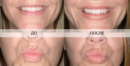 Mărirea buzelor fotografii înainte și după injectarea de acid hialuronic în buze