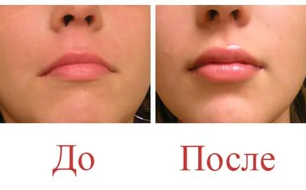 Устни увеличаване с хиалуронова киселина (снимки и препоръки)