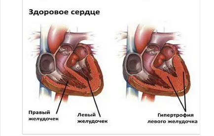 ECG crescută a ventriculului stâng (hipertrofie)