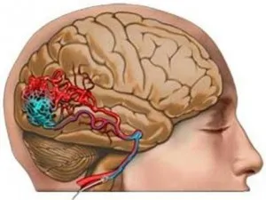 Cerebral Tratamentul angiom venos