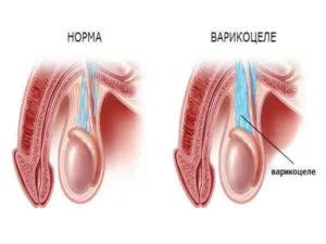 Varice testicule la bărbați - tratament, simptome, intervenții chirurgicale, efecte, fotografie, modul de a trata