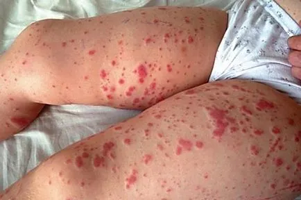 Vasculitis gyermekeknél