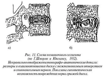 Vertebrogena (vertebrale) torakalgiya la stânga și la dreapta cauze, simptome, tratamentul sindromului