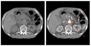 Intravenoasă contrastantă tomografie computerizata abdominala comparativ cu