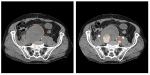 Intravenoasă contrastantă tomografie computerizata abdominala comparativ cu