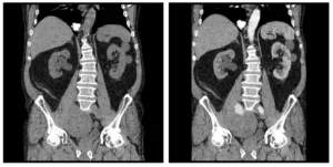 Intravenoasă contrastantă tomografie computerizata abdominala comparativ cu