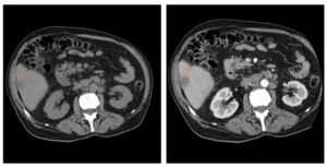 Intravenoasă contrastantă tomografie computerizata abdominala comparativ cu