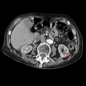 Intravenoasă contrastantă tomografie computerizata abdominala comparativ cu