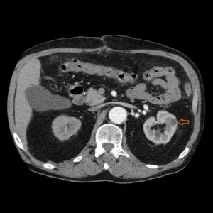 Intravenoasă contrastantă tomografie computerizata abdominala comparativ cu