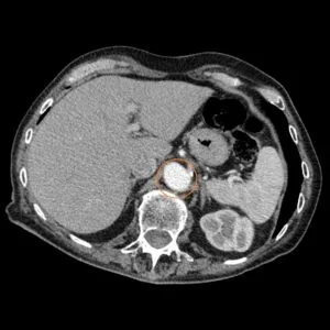 Intravenoasă contrastantă tomografie computerizata abdominala comparativ cu